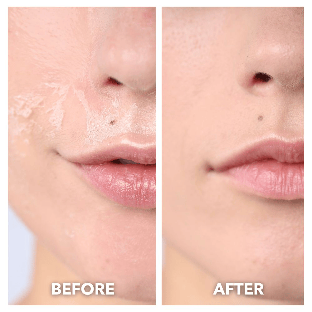 Led Face Therapy